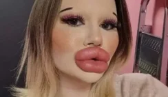 24-year-old Bulgarian woman wants to have the biggest lips in the world