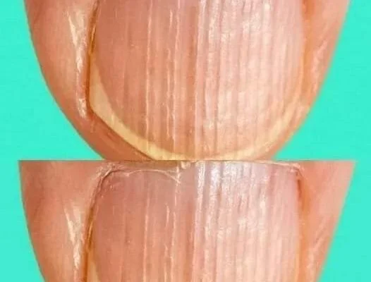 Having Striped Nails Could Mean That Your Body Is…