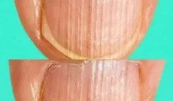 Having Striped Nails Could Mean That Your Body Is…