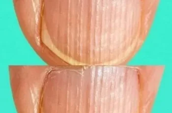 Having Striped Nails Could Mean That Your Body Is…