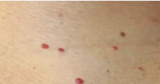 Red dots on your skin: Causes and what they could mean